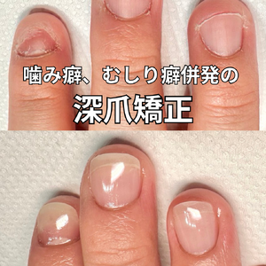 深爪矯正