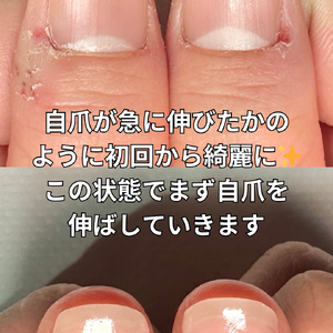深爪矯正