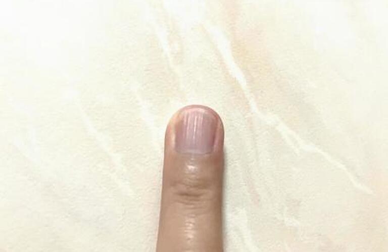 深爪が重度の方も改善できる深爪育成｜熊谷｜自爪育成・深爪矯正・巻き爪矯正専門店 Nailsalon Cure
