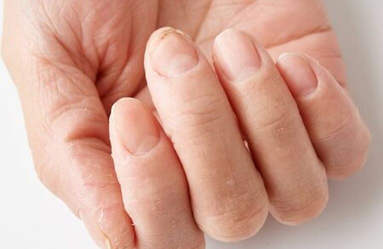 北本で深爪を治すための専門サロンをお探しの方｜自爪育成・深爪矯正・巻き爪矯正専門店 Nailsalon Cure