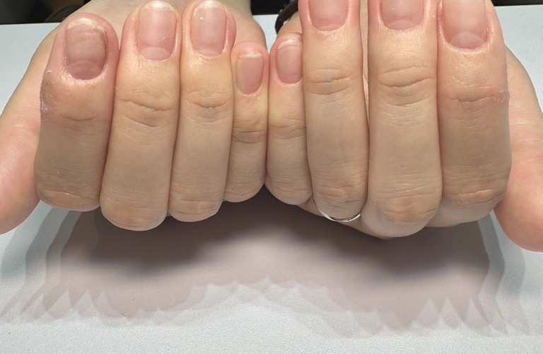 深谷で深爪で爪の白い部分しか伸びない方、ピンクを伸ばす深爪育成｜自爪育成・深爪矯正・巻き爪矯正 Nailsalon Cure