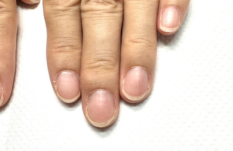 舘林で深爪で爪の白い部分しか伸びない方、ピンクを伸ばす深爪育成｜自爪育成・深爪矯正・巻き爪矯正 Nailsalon Cure